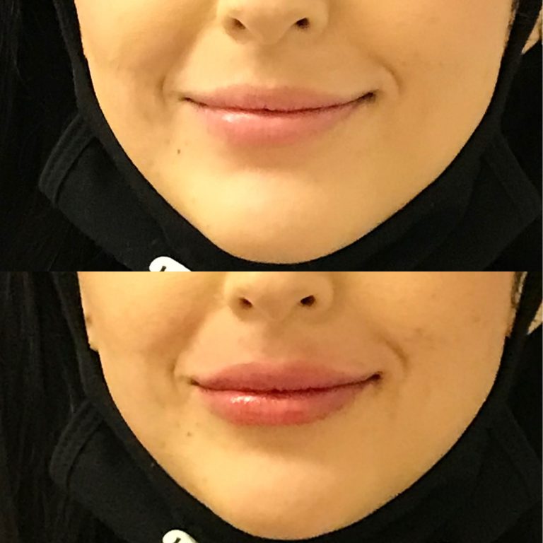 Restylane Kysse Lip Fillers In Santa Rosa And Healdsburg