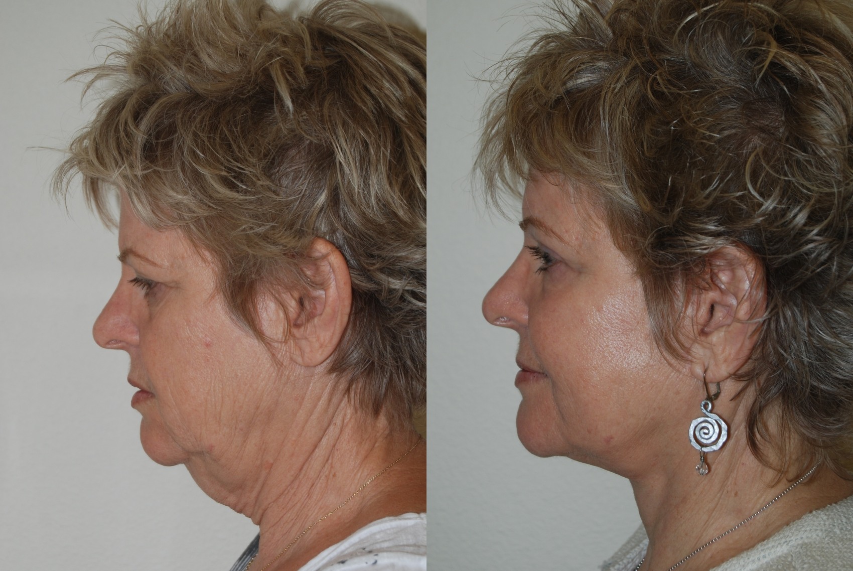 Plastic surgery neck lift