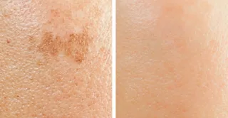 before and after chemical peel to treat hyperpigmentation and uneven skin texture