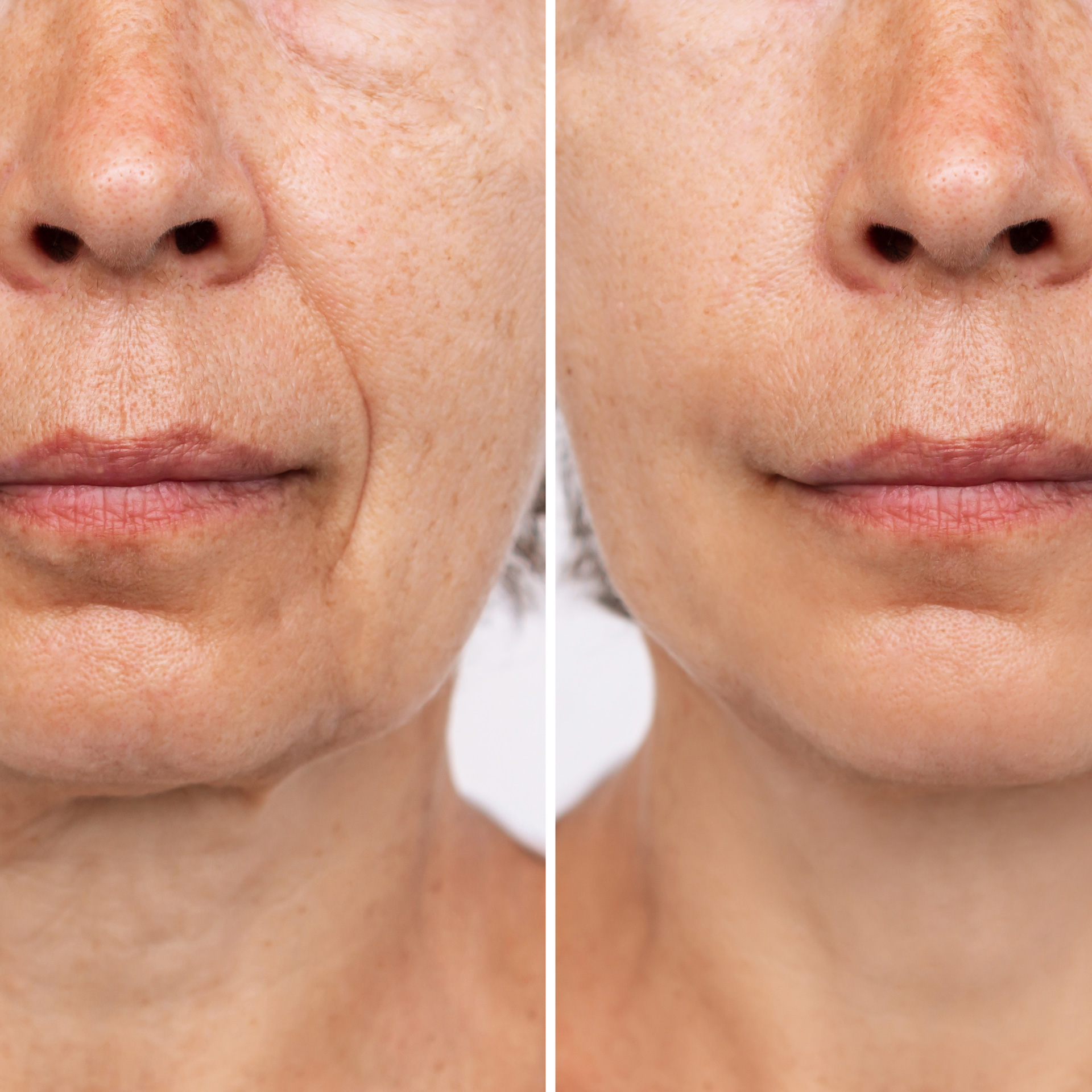 Facelift without Surgery!  Instant Facelift Over 50 
