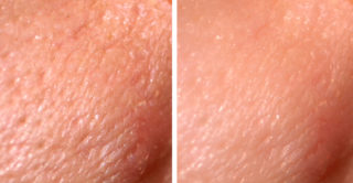 before and after laser resurfacing