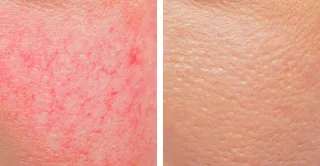 before and after laser spider vein treatment