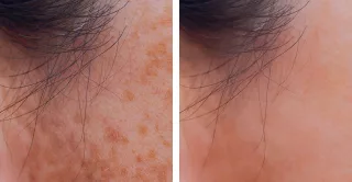 before and after laser pigment correction treatment