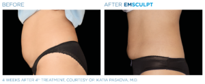 Before and after woman's EmSculpt treatment to reduce fat and encourage muscle growth