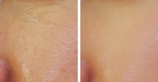 before and after vivace microneedling treatment