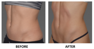 Before and after woman's CoolTone treatment to reduce fat and encourage muscle growth