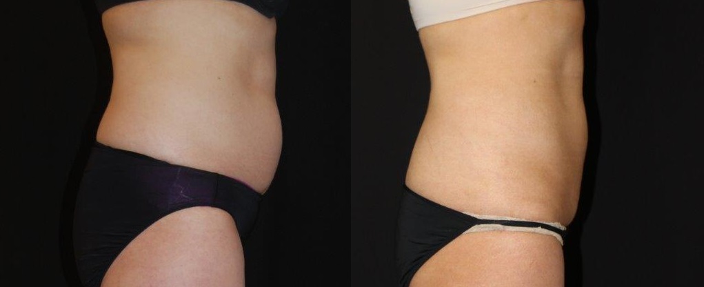 How Modern-Day Body Contouring Treatments Overtook Surgical