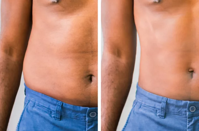 Is Coolsculpting Permanent? All About This Non-Invasive Procedure