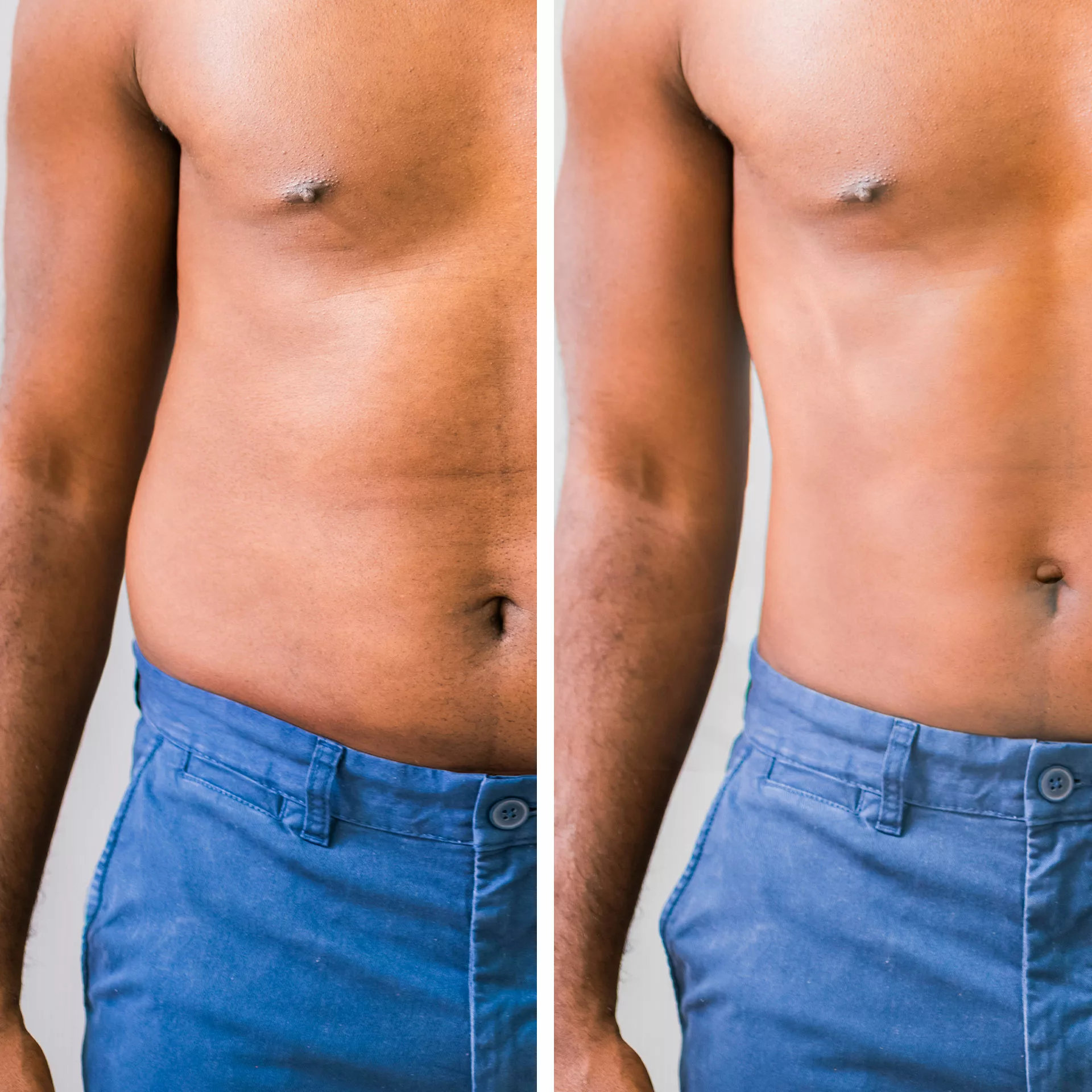 Keep The Love, Lose The Love Handles With CoolSculpting