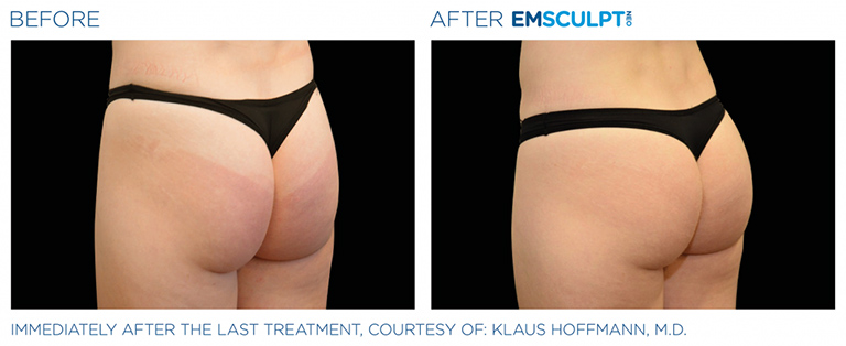 Emsculpt Neo® is a revolutionary body sculpting treatment that has taken  the world by storm. It is a non-invasive procedure that uses hi