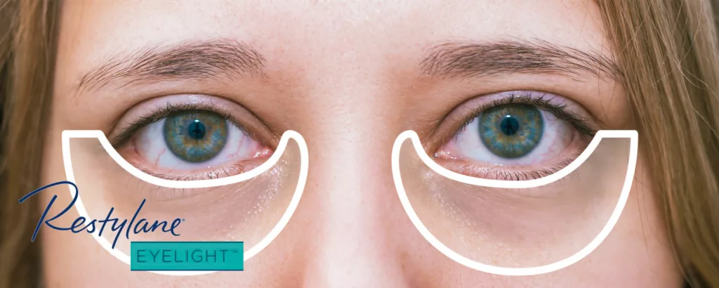 diagram showing how Restylane Eyelight tear trough filler can address dark undereye circles
