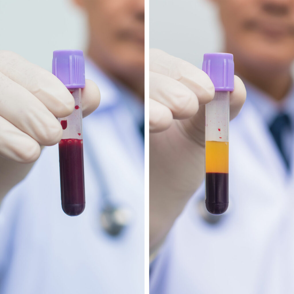 blood before and after going through a centrifuge to create PRP